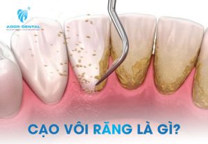 Cạo vôi răng