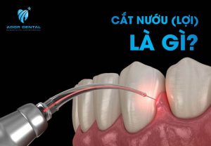 Khái niệm cắt nướu lợi