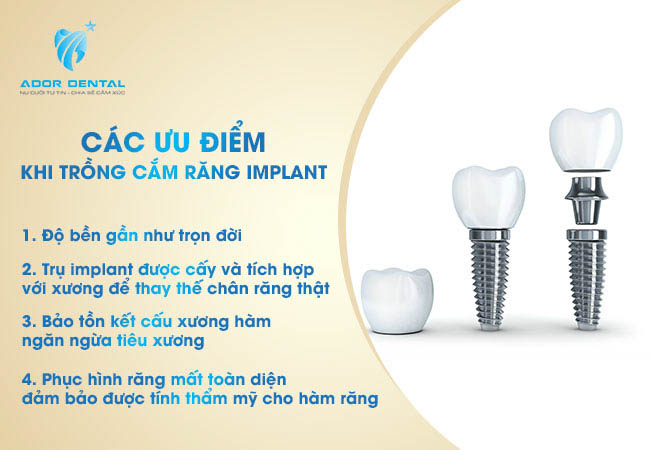 Các ưu điểm khi trồng răng implant