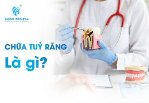 Khái niệm về chữa tủy răng