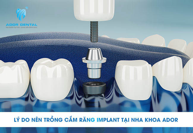 Lý do nên chọn trồng cắm răng implant tại ADOR DENTAL