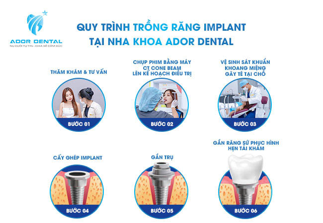Quy trình trồng răng Implant rỏ ràng
