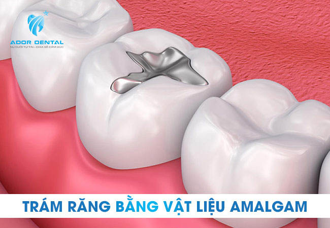 Trám răng bằng vật liệu Amalgam