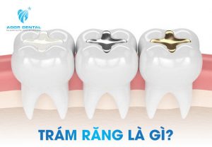 Khái niệm về phương pháp trám răng