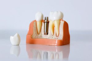 Trồng răng implant