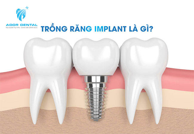Khái niệng trồng răng implant