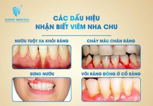 Các dấu hiệu nhận biết bệnh viêm nha chu