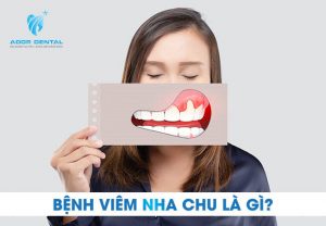 Bệnh viêm nha chu là bệnh gì