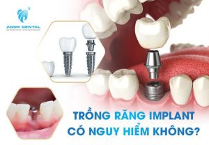 Trồng răng Implant có nguy hiểm không