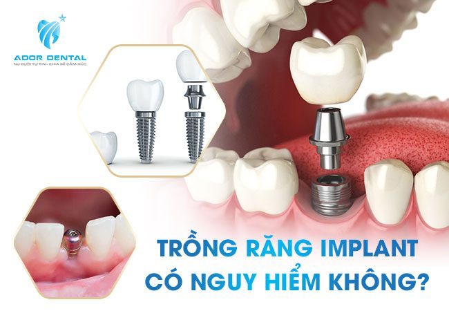 Trồng răng Implant có nguy hiểm không