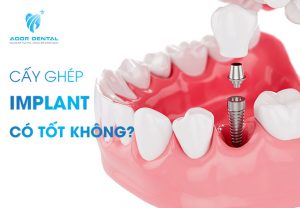 Cấy ghép Implant có tốt không?