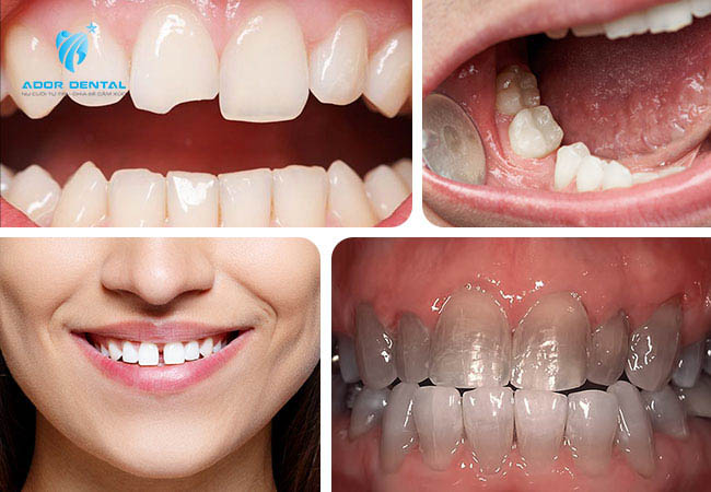 Tình trạng khuyết tật của răng