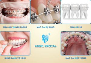 Lựa chọn phương pháp niềng răng