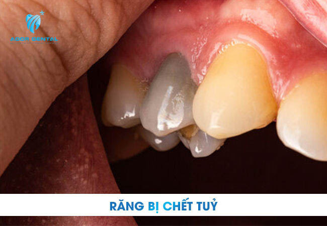 Điều trị tủy răng tại Tây Ninh