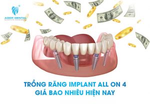 trồng răng implant all on 4