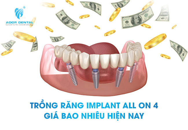 trồng răng implant all on 4