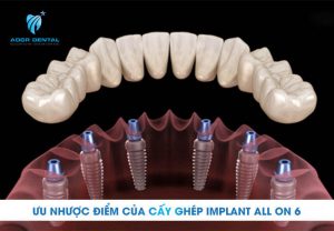 trồng răng implant all on 6