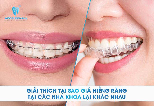 Bảng giá niềng răng tạ các nha khoa khác nhau