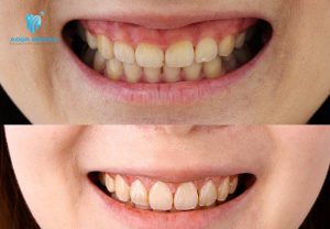 Dịch vụ điều trị cười hở lợi