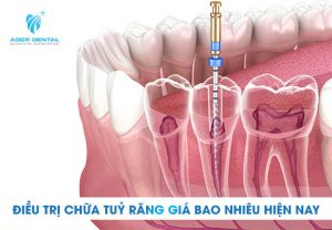 Chi phí chữa tủy răng hiện nay