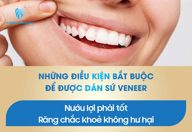 Những điều kiện bắt buộc để được dán răng sứ Veneer