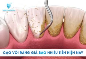 Cạo vôi răng giá bao nhiêu tiền hiện nay