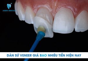 Dán sứ veneer giá bao nhiêu tiền hiện nay