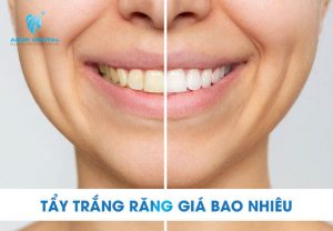 Giá tẩy trắng răng tại nha khoa