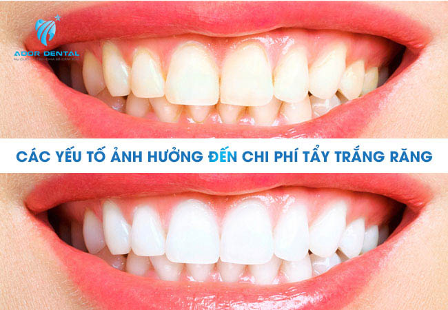Các yếu tố ảnh hưởng tới chi phí tẩy trắng răng