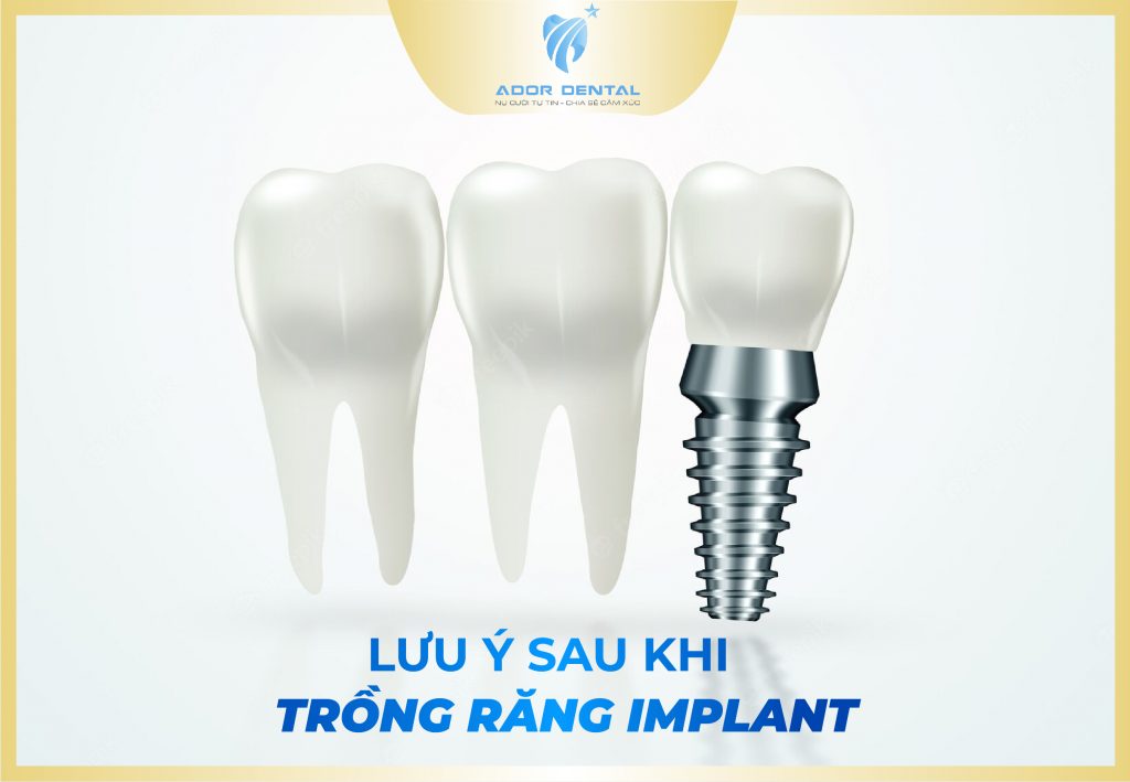lưu ý sau khi trồng răng implant