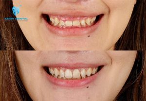 Phẫu thuật làm dài thân răng