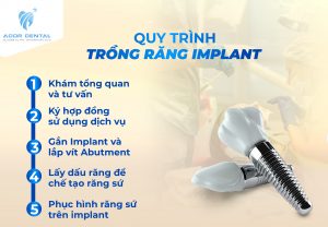 Quy trình trồng răng implant