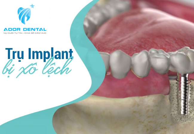 Răng Implant lệch so với răng thật  hoặc lệch khớp cắn