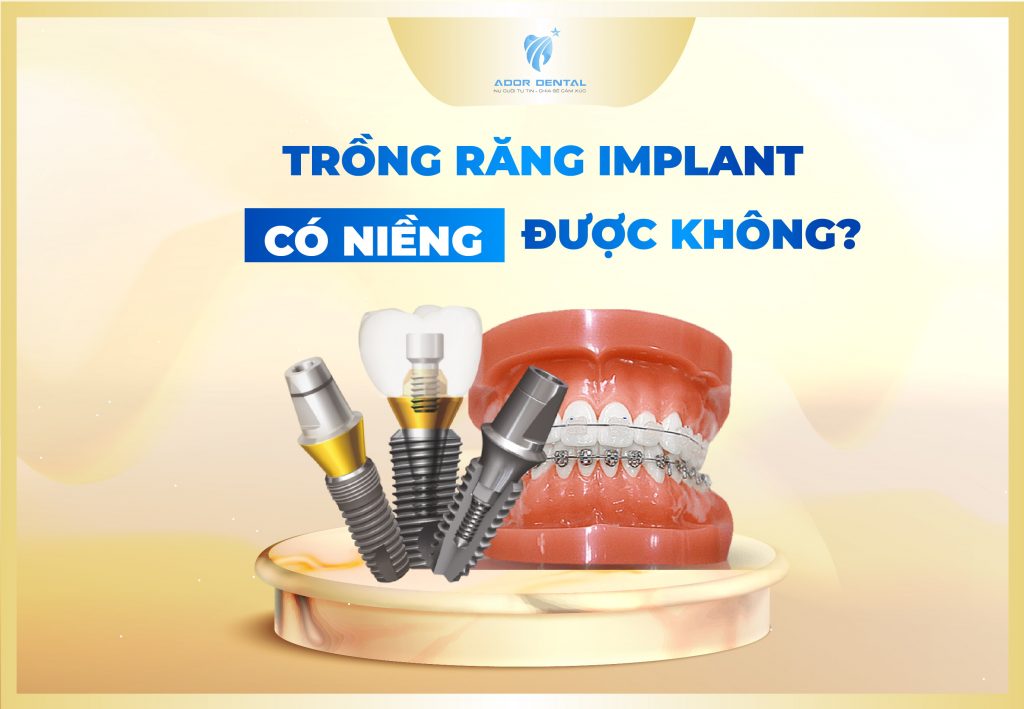 trồng răng Implant có niềng răng được không