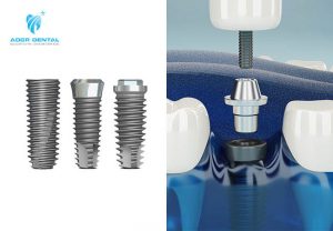 Phương pháp trồng răng implant