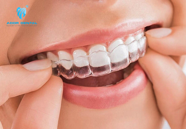 Niềng răng Invisalign 2 hàm có giá từ 90- 180 triệu đồng