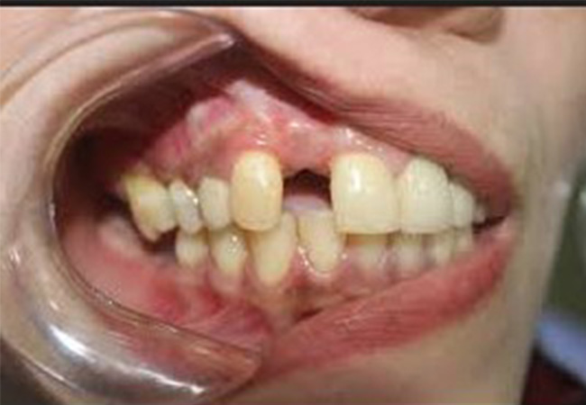 Người bị mất răng lâu năm có thể trồng Implant được không