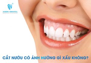 Cắt lợi có ảnh hưởng gì không