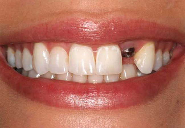 Cấy implant sau khi nhổ răng 1 – 2 tháng