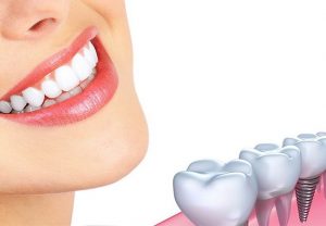 Công nghệ cấy ghép Implant có độ thẩm mỹ cao
