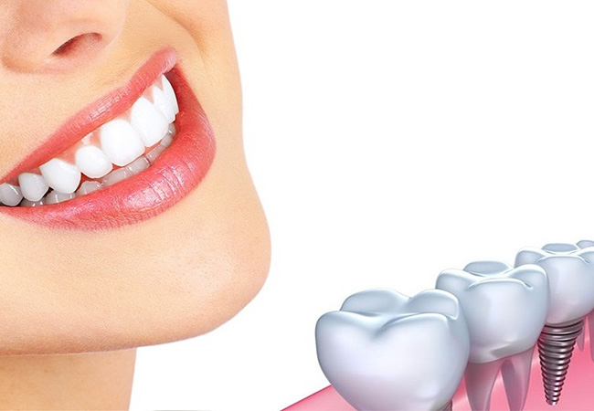 Cấy implant sau khi nhổ răng 3 – 4 tháng