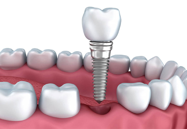 Cấy implant sau khi nhổ răng 4 – 12 tháng