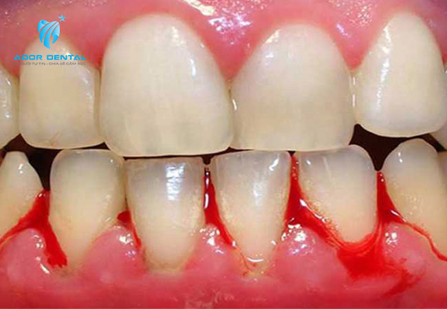 Răng bị viêm nha chu