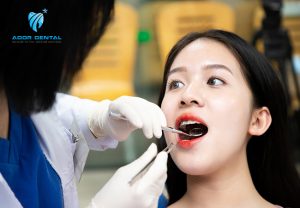 Niềng Răng Hô Nhẹ Bao Nhiêu Tiền? Giá Rẻ Nhất Là Bao Nhiêu