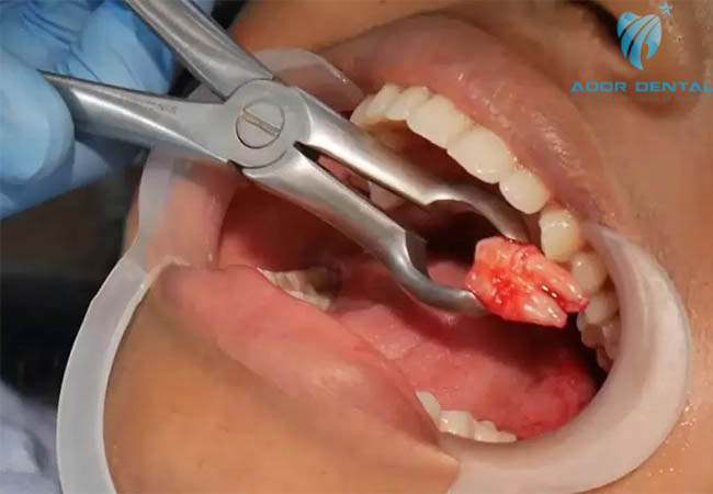 dịch vụ nhổ răng ở Tây Ninh