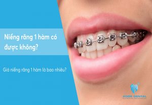 Mức Giá Niềng Răng 1 Hàm Khoảng Bao Nhiêu