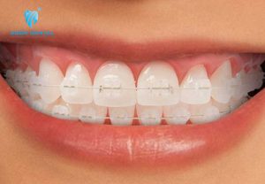 Giá Niềng Răng 2 Hàm Bao Nhiêu Tiền? Loại Nào Tốt Nhất?
