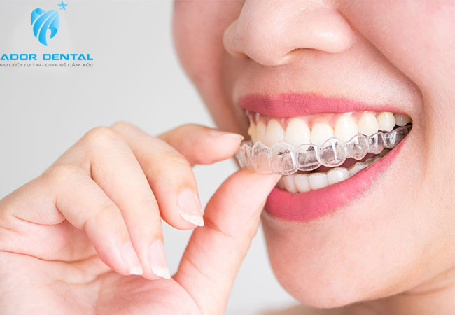 Thời gian niềng răng 1 hàm dao động khoảng từ 1 - 2 năm