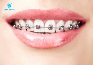 Niềng Răng Thưa Bao Nhiêu Tiền? Địa Chỉ Niềng Răng Thưa Ở Đâu Rẻ?