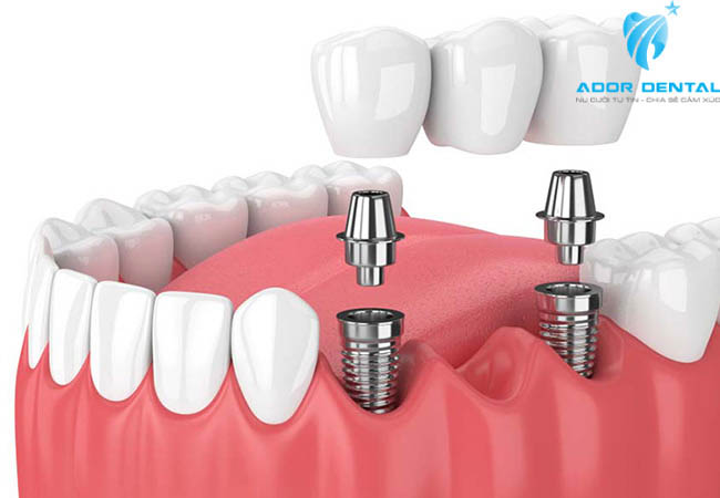 Trồng răng Implant có bền không?